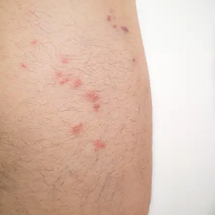 Flea bites on a person's leg - Keep fleas away from your home with Assured Environments in NY